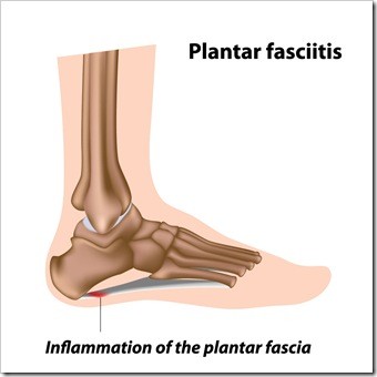Foot Pain Sandy Springs GA Plantar Fasciitis