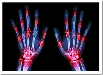 Rheumatoid Arthritis Solutions Sandy Springs GA