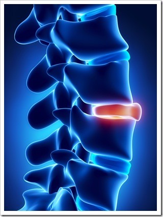 Slipped Disc Sandy Springs GA